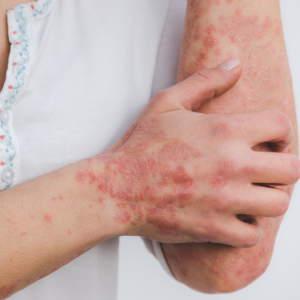 Problème peau eczéma psoriasis Claire Cavelier